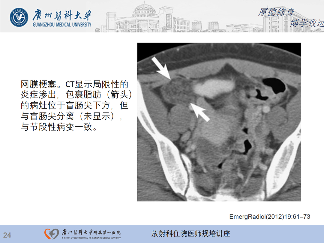 影像PPT - 【PPT】急性阑尾炎影像诊断思考和综述-88