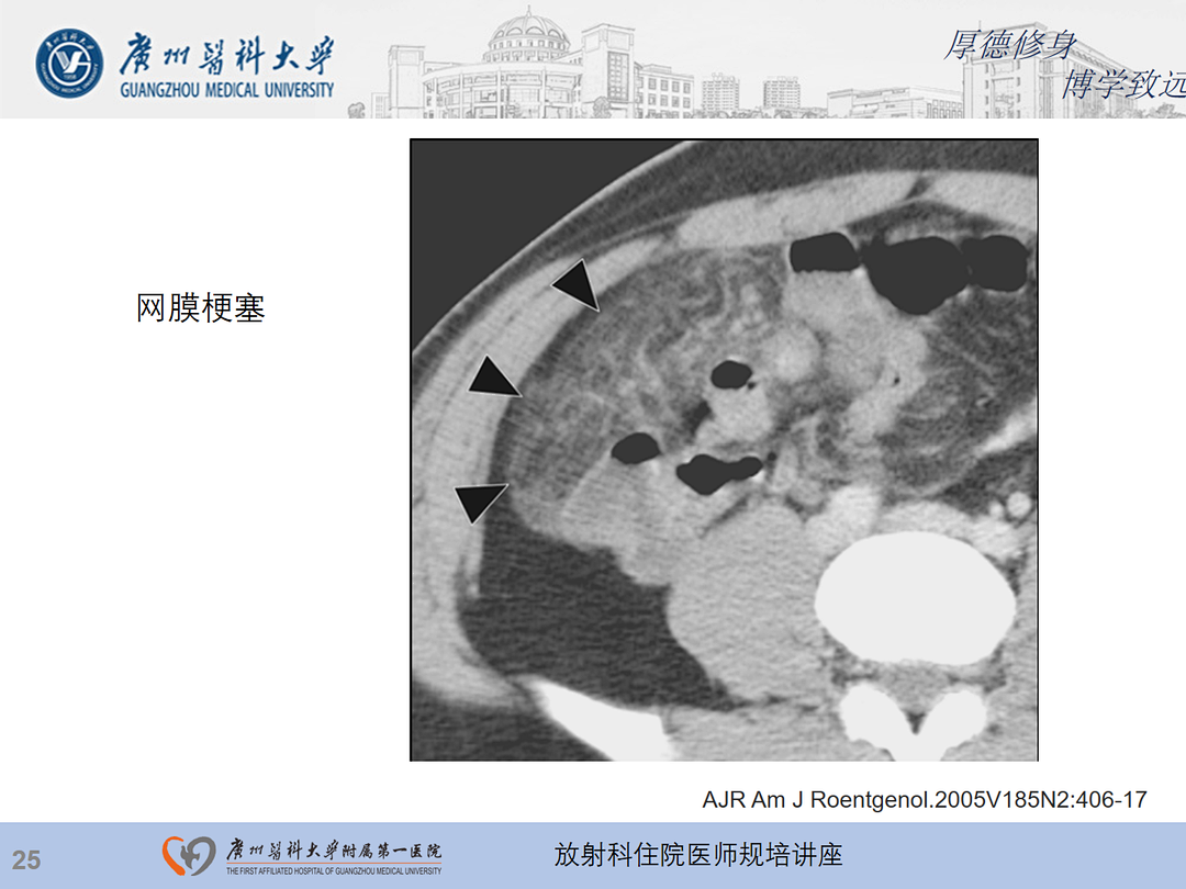 影像PPT - 【PPT】急性阑尾炎影像诊断思考和综述-89