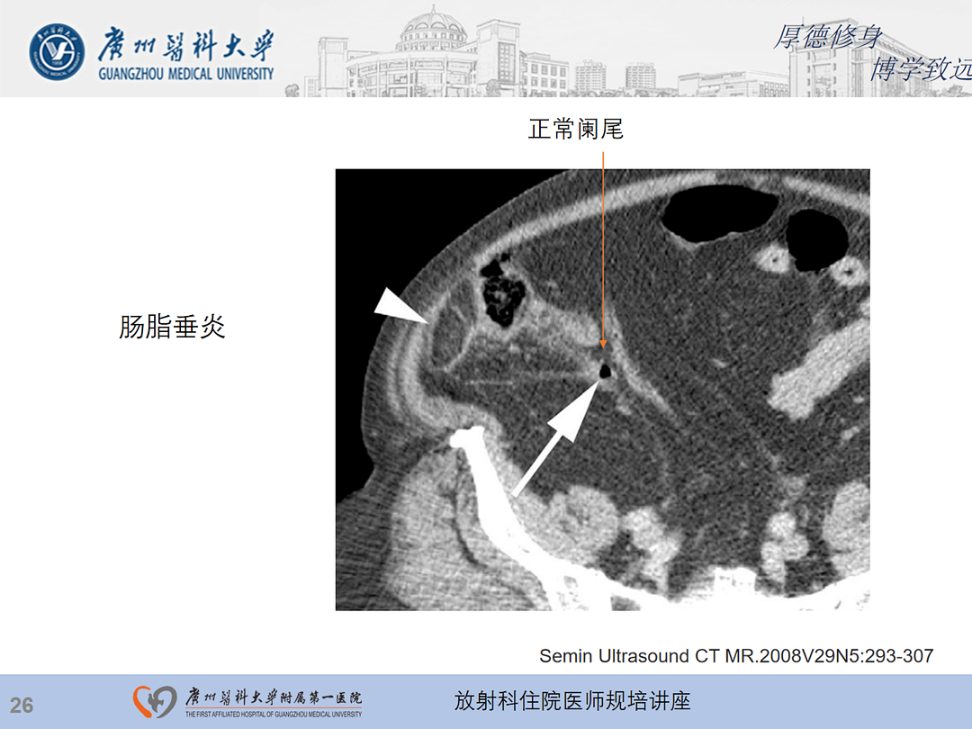 影像PPT - 【PPT】急性阑尾炎影像诊断思考和综述-90
