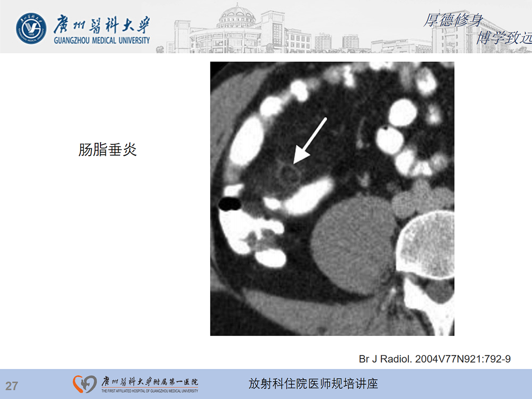 影像PPT - 【PPT】急性阑尾炎影像诊断思考和综述-91