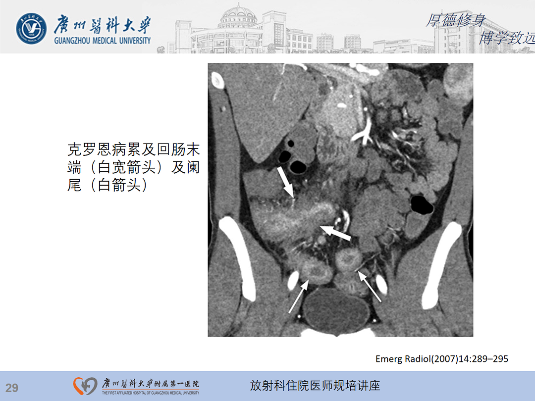 影像PPT - 【PPT】急性阑尾炎影像诊断思考和综述-93
