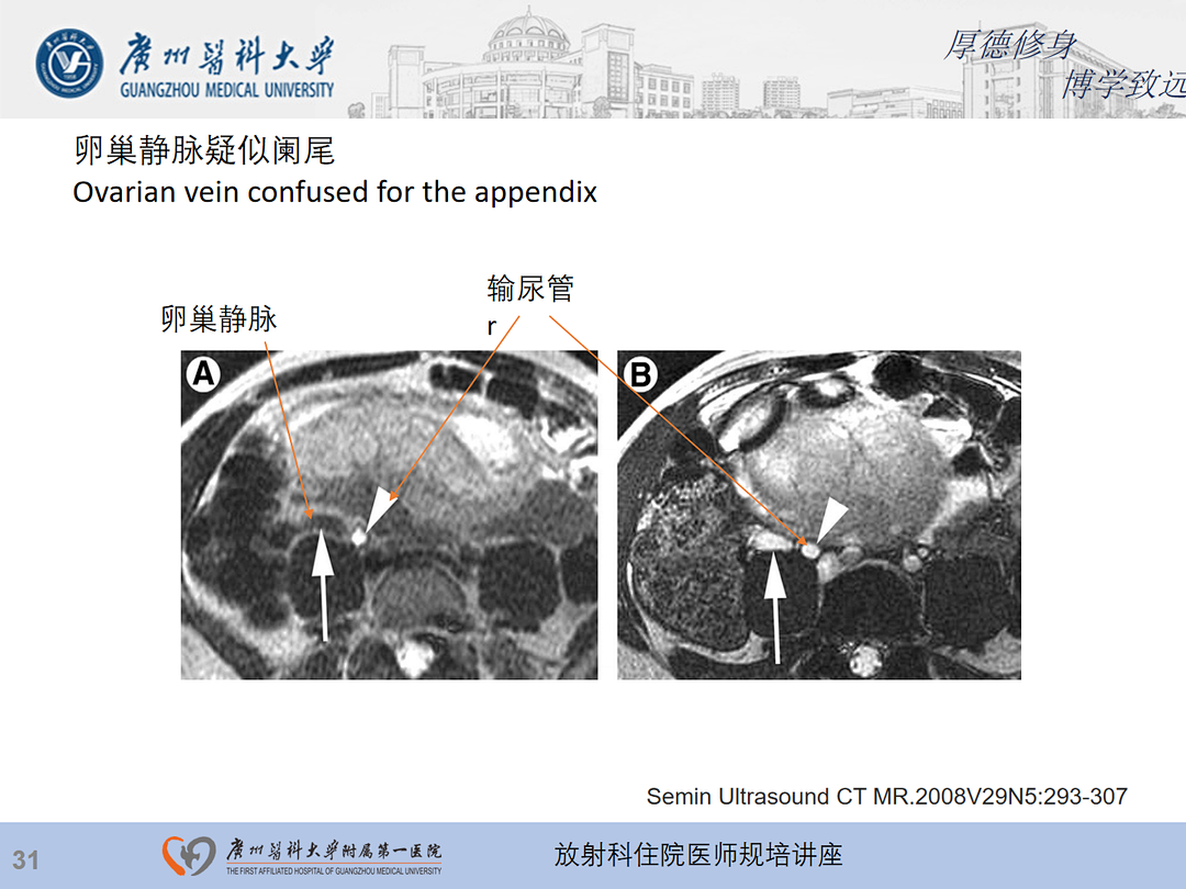 影像PPT - 【PPT】急性阑尾炎影像诊断思考和综述-95