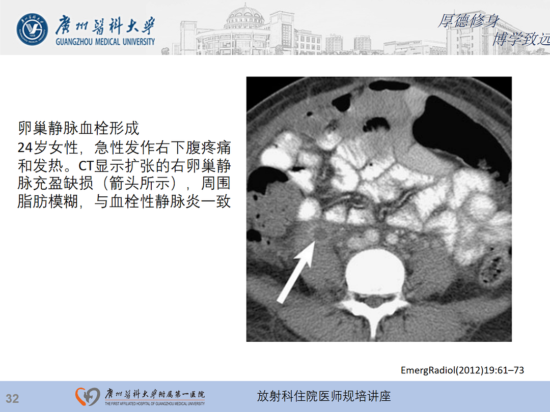 影像PPT - 【PPT】急性阑尾炎影像诊断思考和综述-96