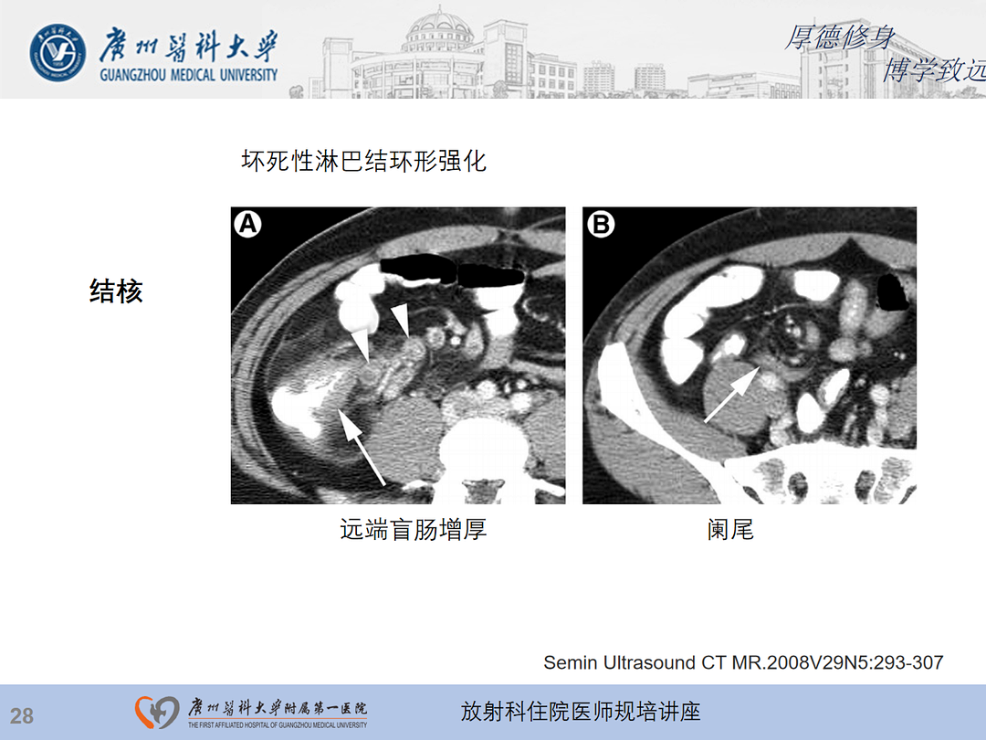 影像PPT - 【PPT】急性阑尾炎影像诊断思考和综述-92