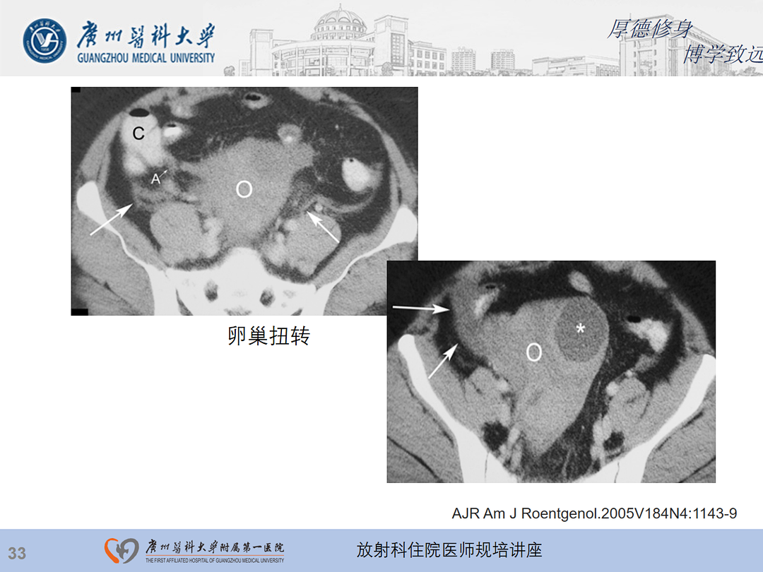 影像PPT - 【PPT】急性阑尾炎影像诊断思考和综述-97