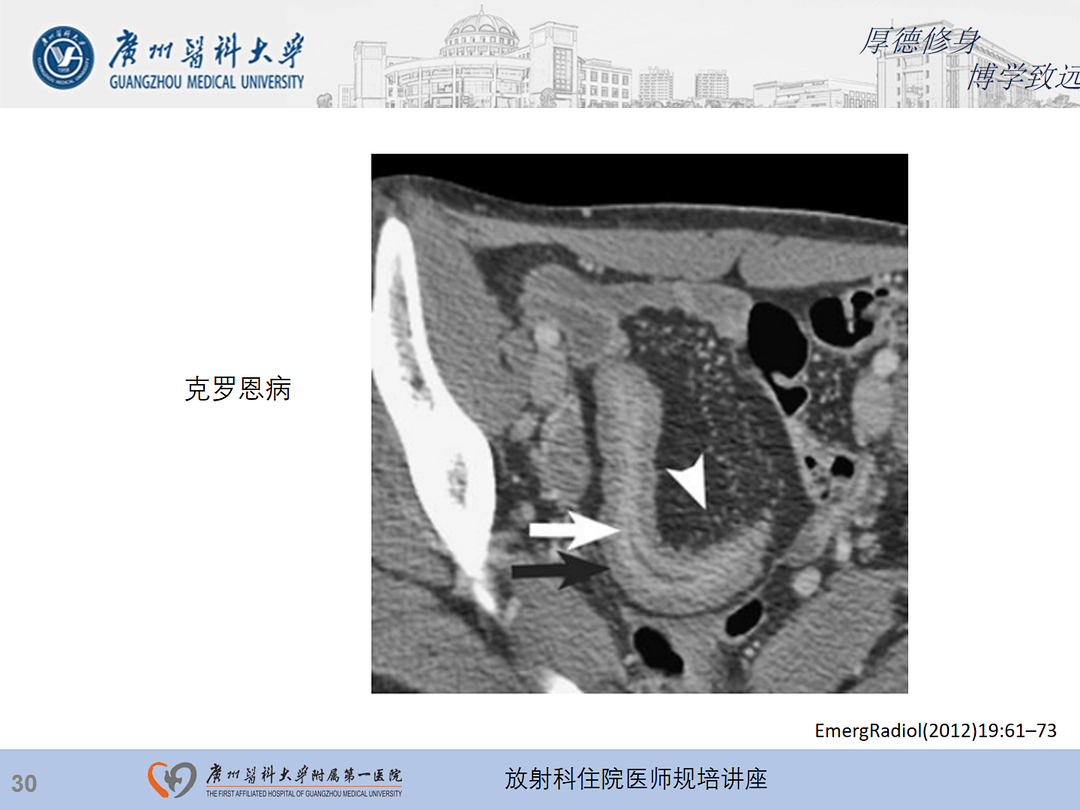 影像PPT - 【PPT】急性阑尾炎影像诊断思考和综述-94