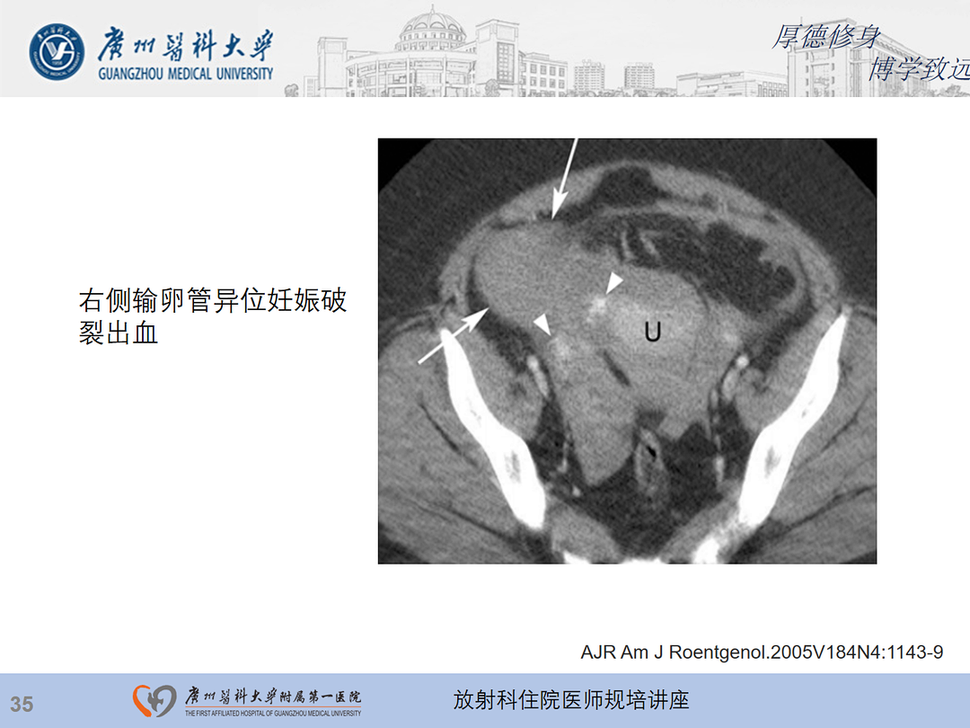 影像PPT - 【PPT】急性阑尾炎影像诊断思考和综述-99
