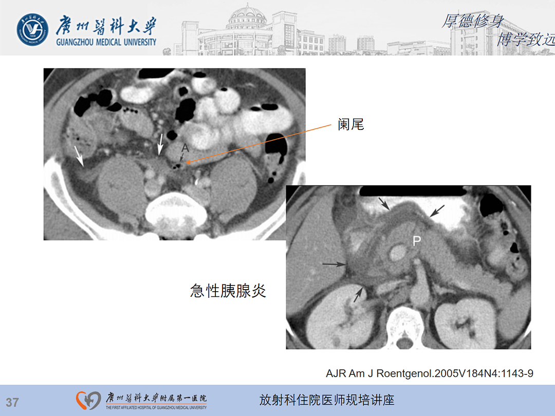 影像PPT - 【PPT】急性阑尾炎影像诊断思考和综述-101