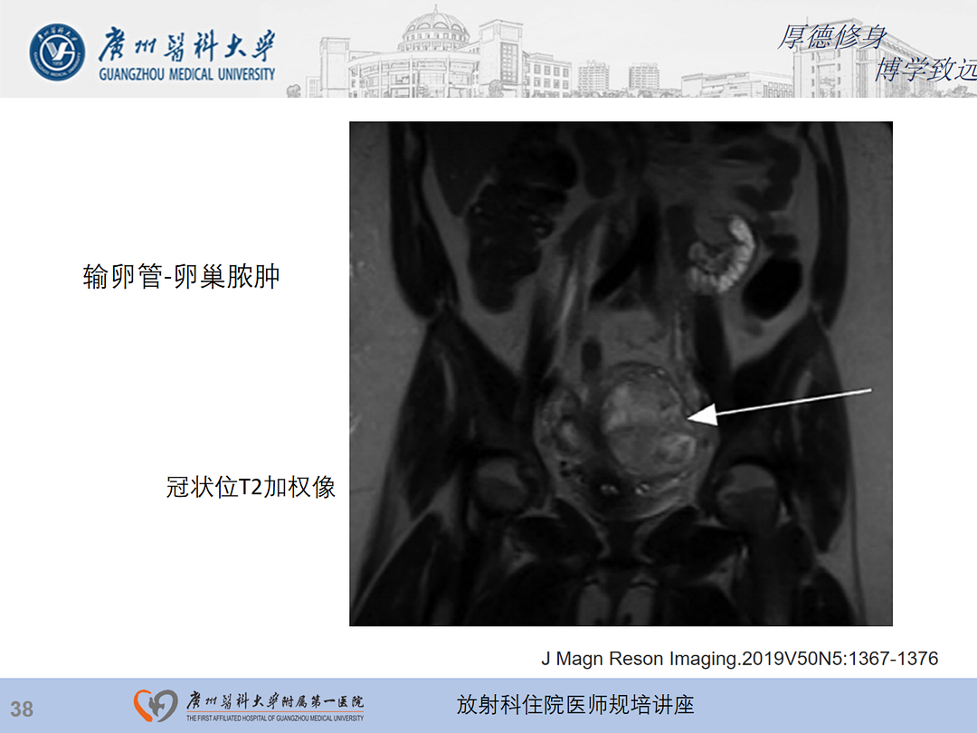 影像PPT - 【PPT】急性阑尾炎影像诊断思考和综述-102