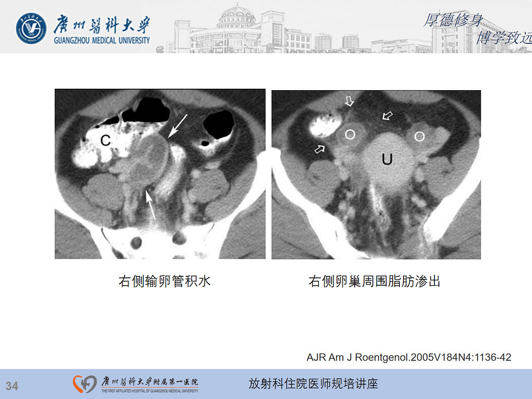影像PPT - 【PPT】急性阑尾炎影像诊断思考和综述-98