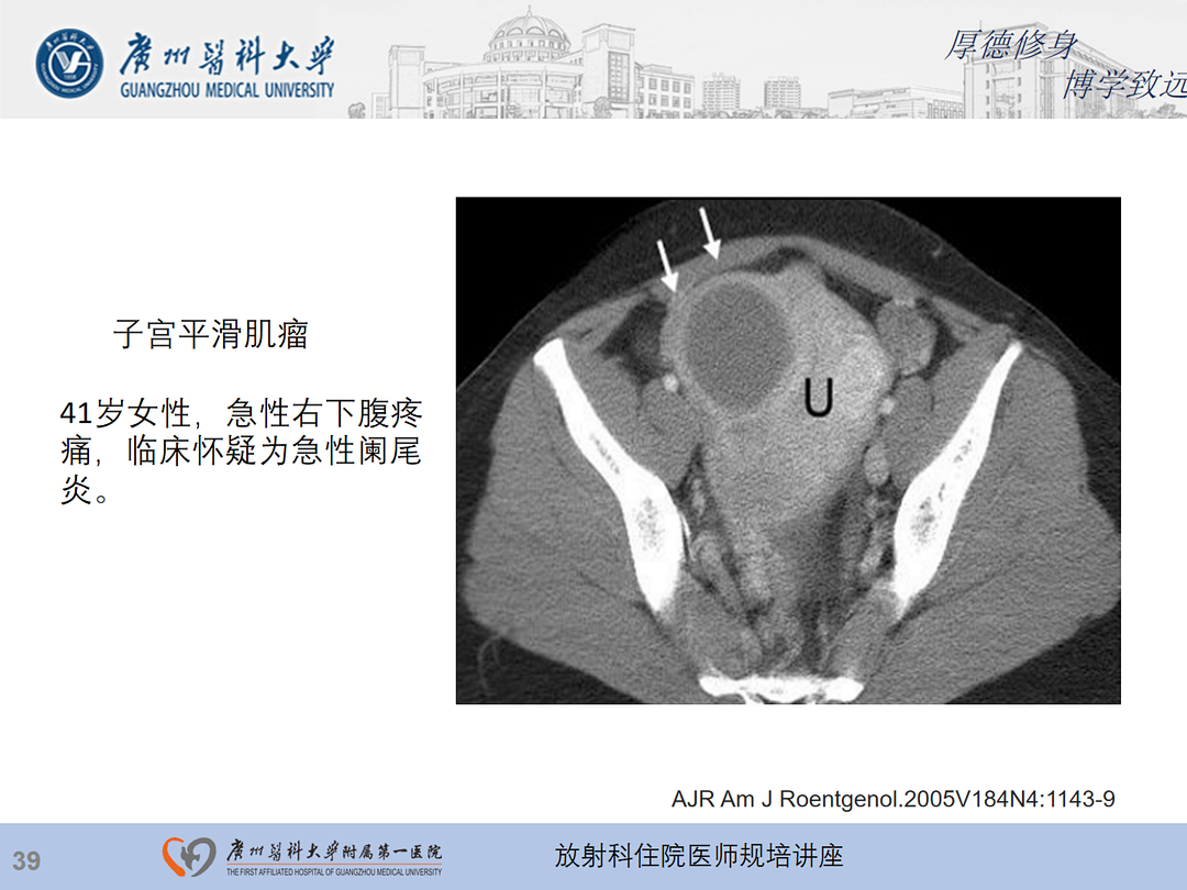 影像PPT - 【PPT】急性阑尾炎影像诊断思考和综述-103