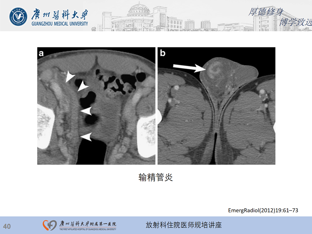 影像PPT - 【PPT】急性阑尾炎影像诊断思考和综述-104