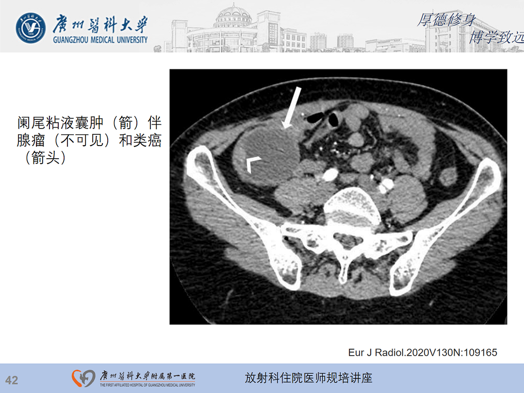 影像PPT - 【PPT】急性阑尾炎影像诊断思考和综述-106