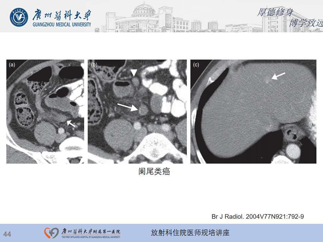 影像PPT - 【PPT】急性阑尾炎影像诊断思考和综述-108