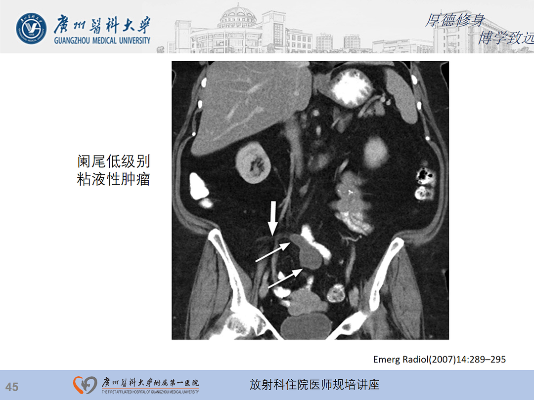 影像PPT - 【PPT】急性阑尾炎影像诊断思考和综述-109
