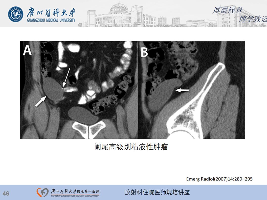 影像PPT - 【PPT】急性阑尾炎影像诊断思考和综述-110