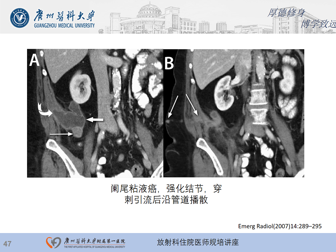 影像PPT - 【PPT】急性阑尾炎影像诊断思考和综述-111