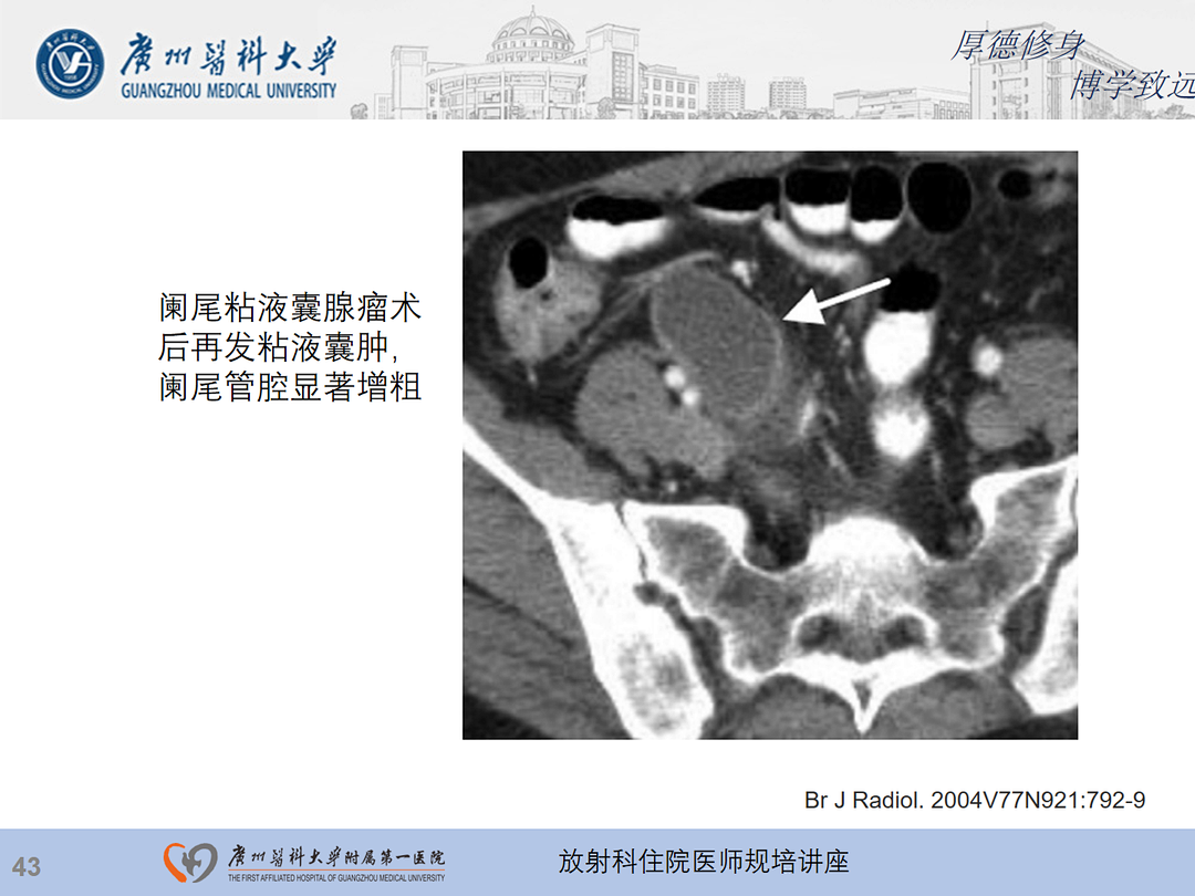 影像PPT - 【PPT】急性阑尾炎影像诊断思考和综述-107