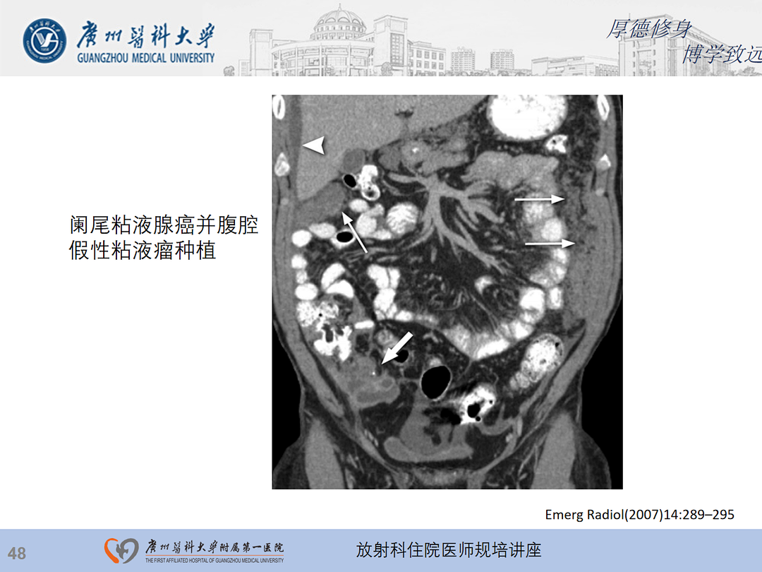 影像PPT - 【PPT】急性阑尾炎影像诊断思考和综述-112