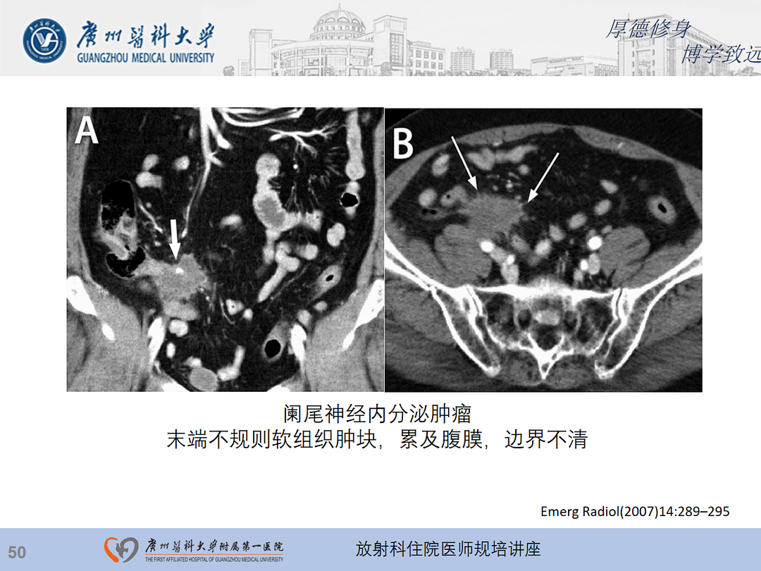 影像PPT - 【PPT】急性阑尾炎影像诊断思考和综述-114