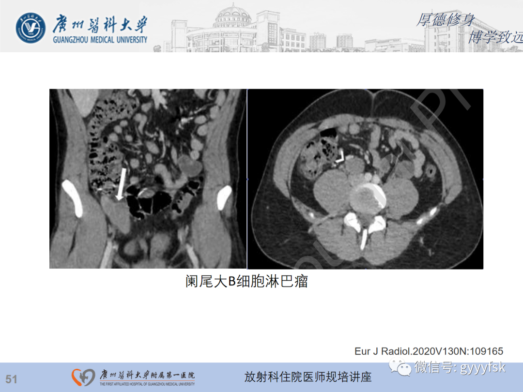 影像PPT - 【PPT】急性阑尾炎影像诊断思考和综述-115