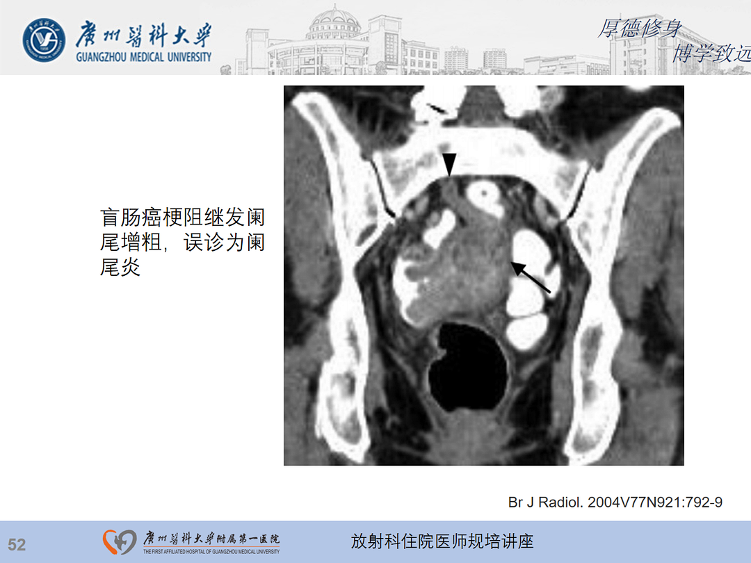 影像PPT - 【PPT】急性阑尾炎影像诊断思考和综述-116