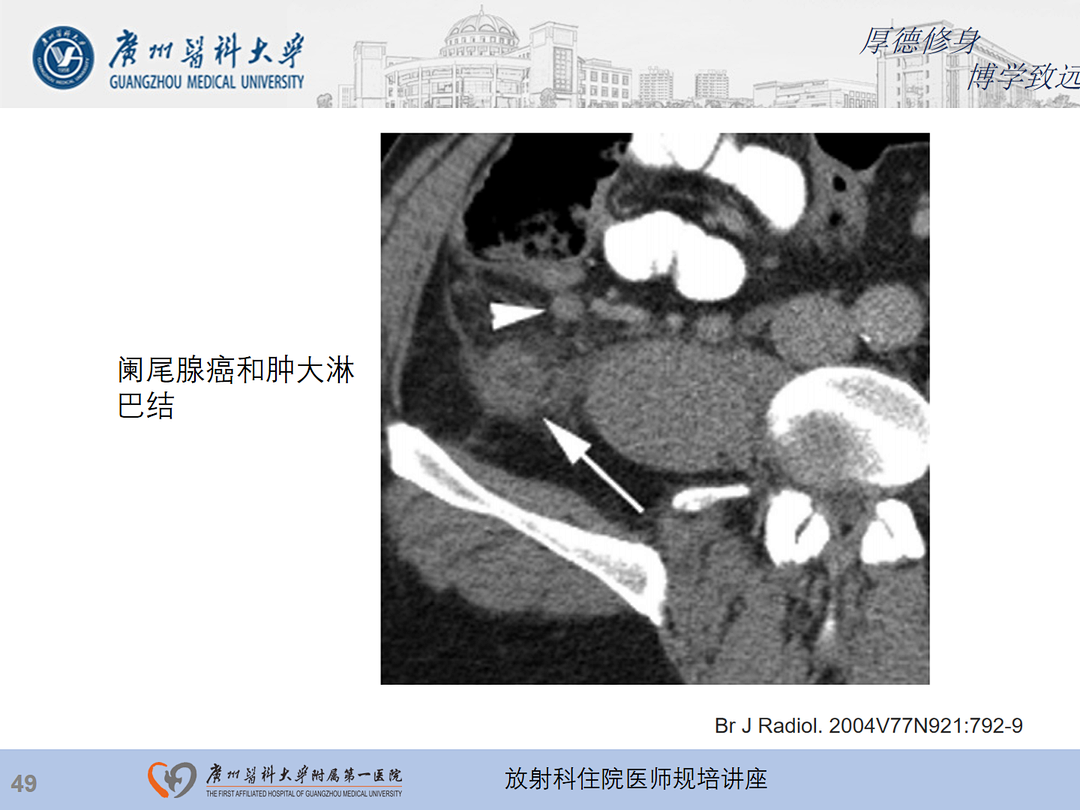 影像PPT - 【PPT】急性阑尾炎影像诊断思考和综述-113