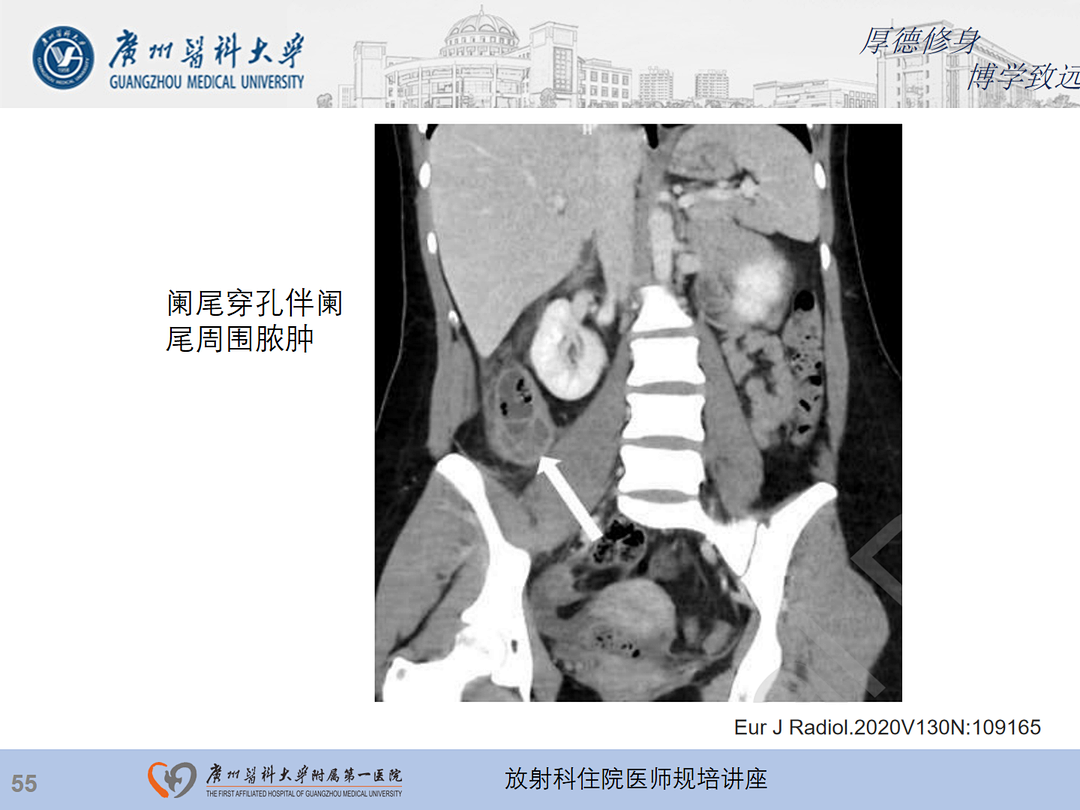 影像PPT - 【PPT】急性阑尾炎影像诊断思考和综述-119