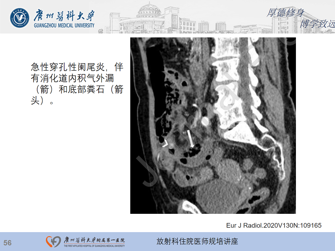 影像PPT - 【PPT】急性阑尾炎影像诊断思考和综述-120