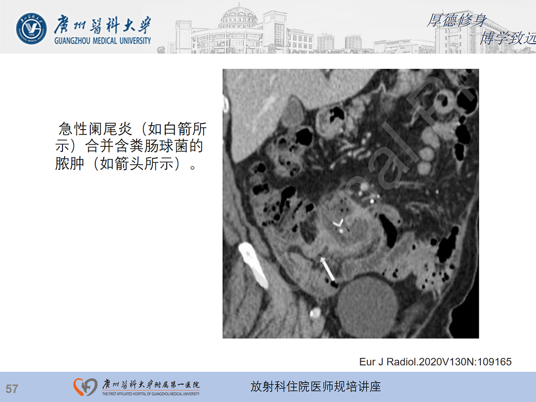 影像PPT - 【PPT】急性阑尾炎影像诊断思考和综述-121