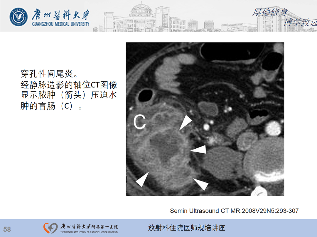 影像PPT - 【PPT】急性阑尾炎影像诊断思考和综述-122