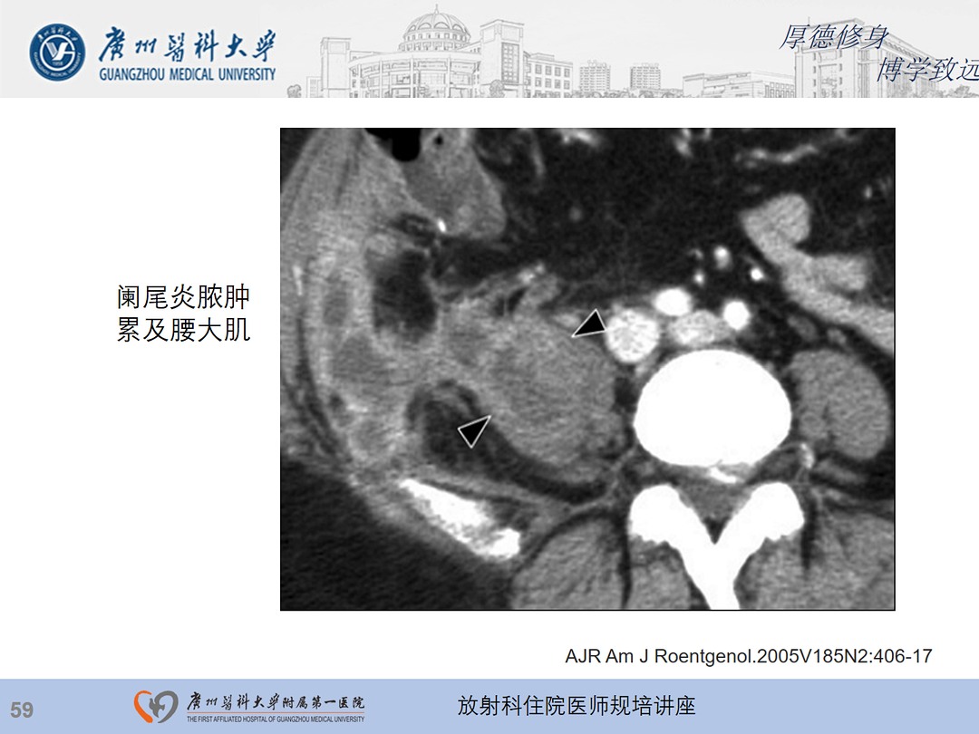 影像PPT - 【PPT】急性阑尾炎影像诊断思考和综述-123