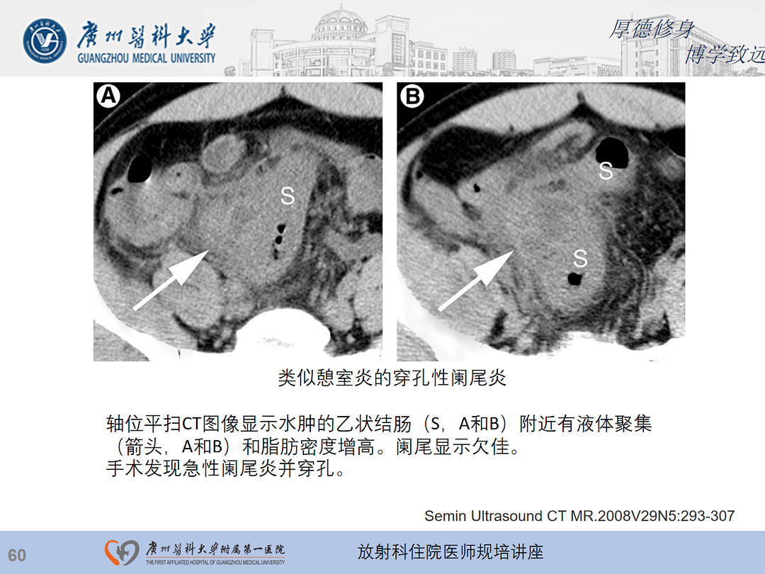 影像PPT - 【PPT】急性阑尾炎影像诊断思考和综述-124