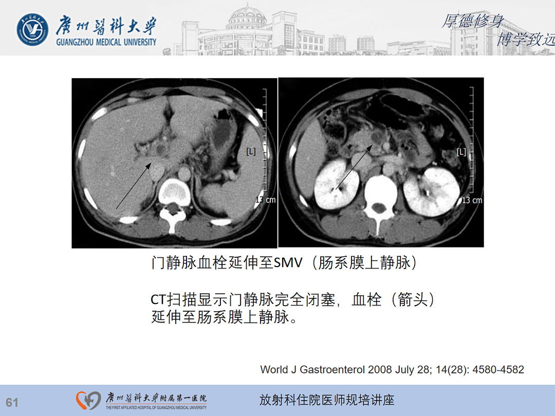 影像PPT - 【PPT】急性阑尾炎影像诊断思考和综述-125