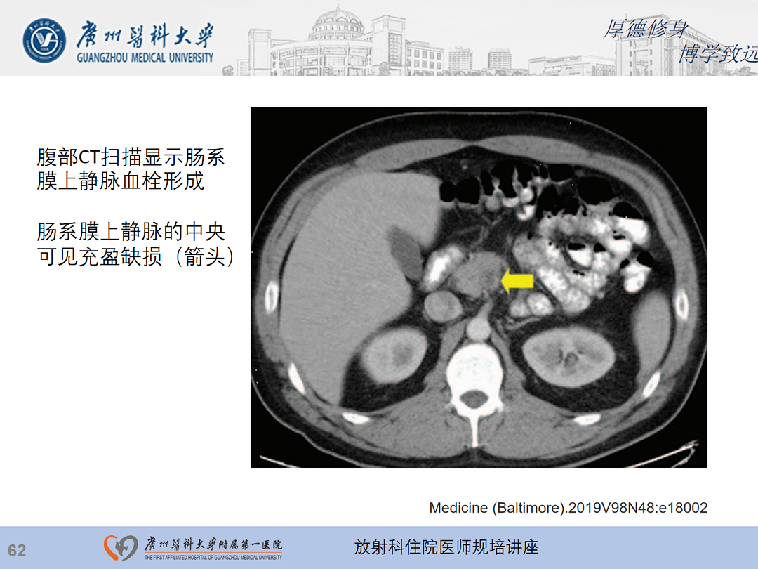 影像PPT - 【PPT】急性阑尾炎影像诊断思考和综述-126