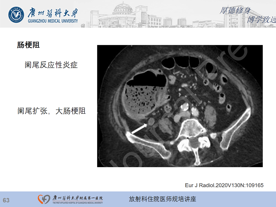 影像PPT - 【PPT】急性阑尾炎影像诊断思考和综述-127
