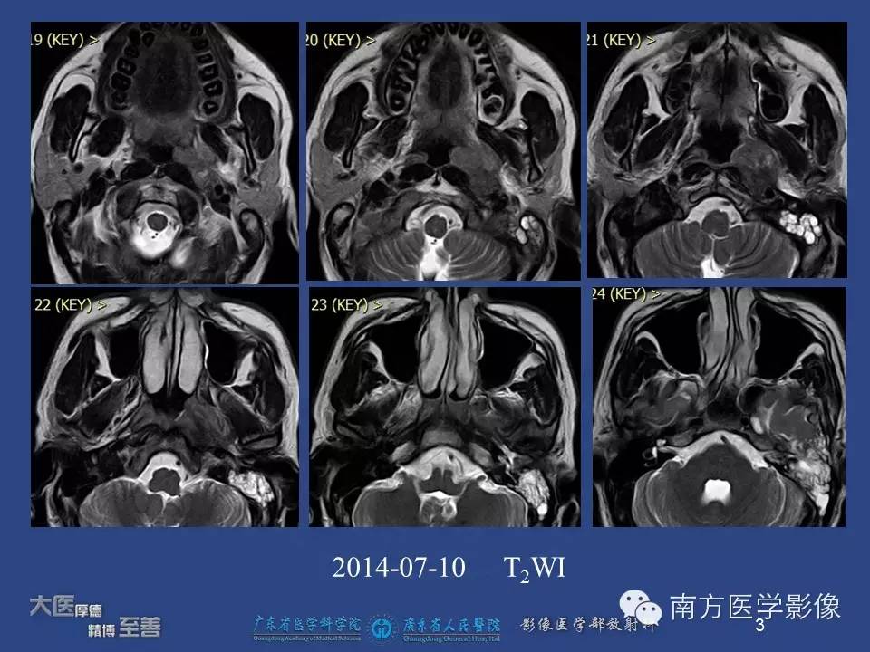 影像PPT - 【PPT】鼻咽癌累及中耳及与中耳炎的鉴别-3