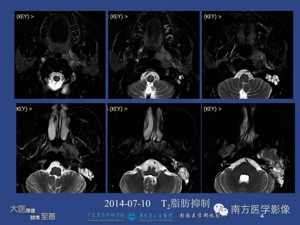 影像PPT - 【PPT】鼻咽癌累及中耳及与中耳炎的鉴别-4