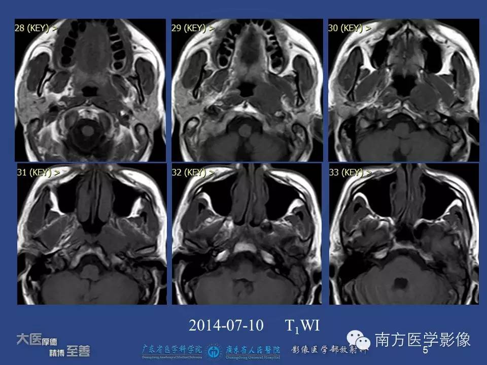 影像PPT - 【PPT】鼻咽癌累及中耳及与中耳炎的鉴别-5
