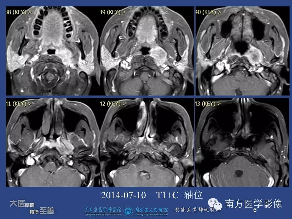 影像PPT - 【PPT】鼻咽癌累及中耳及与中耳炎的鉴别-6