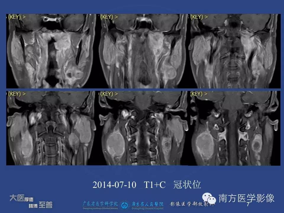 影像PPT - 【PPT】鼻咽癌累及中耳及与中耳炎的鉴别-7