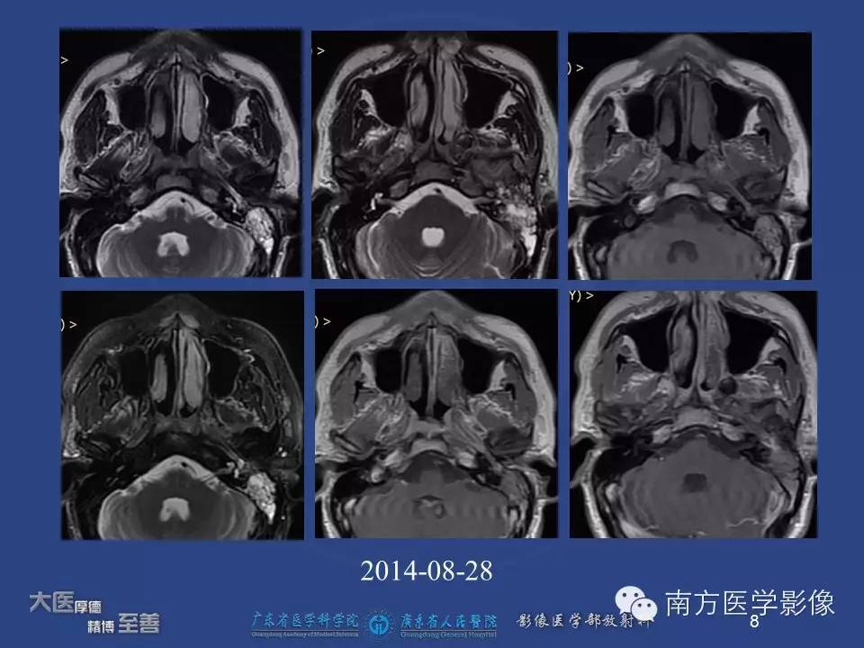 影像PPT - 【PPT】鼻咽癌累及中耳及与中耳炎的鉴别-8