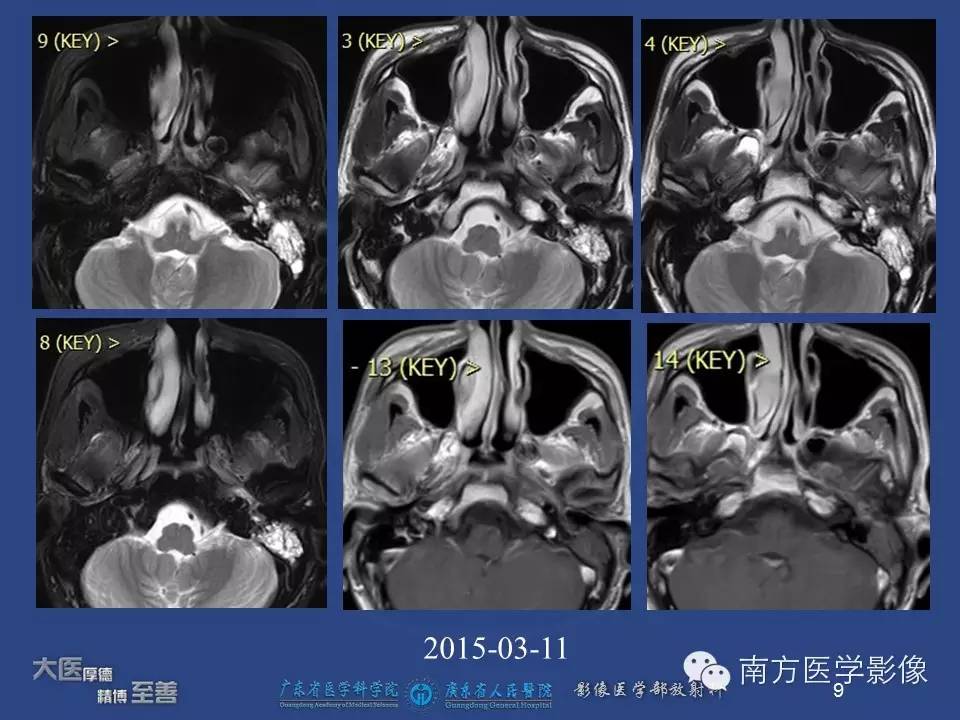 影像PPT - 【PPT】鼻咽癌累及中耳及与中耳炎的鉴别-9