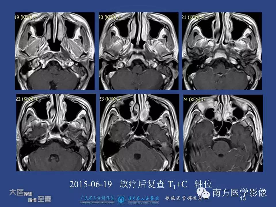 影像PPT - 【PPT】鼻咽癌累及中耳及与中耳炎的鉴别-13