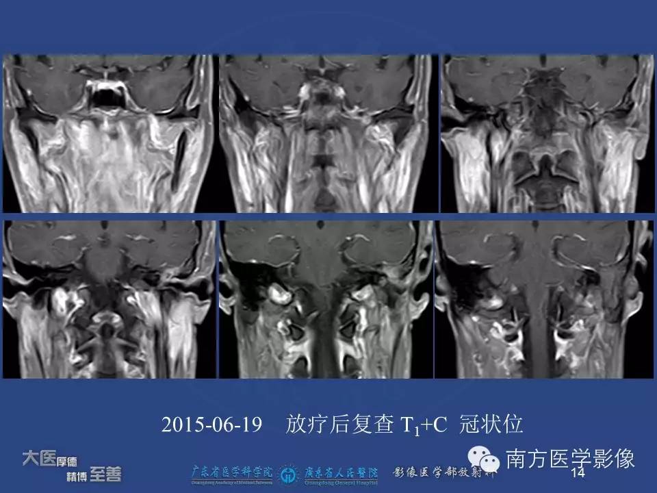 影像PPT - 【PPT】鼻咽癌累及中耳及与中耳炎的鉴别-14
