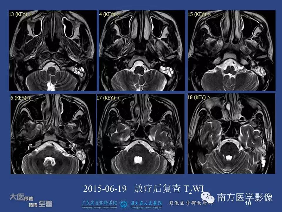 影像PPT - 【PPT】鼻咽癌累及中耳及与中耳炎的鉴别-10
