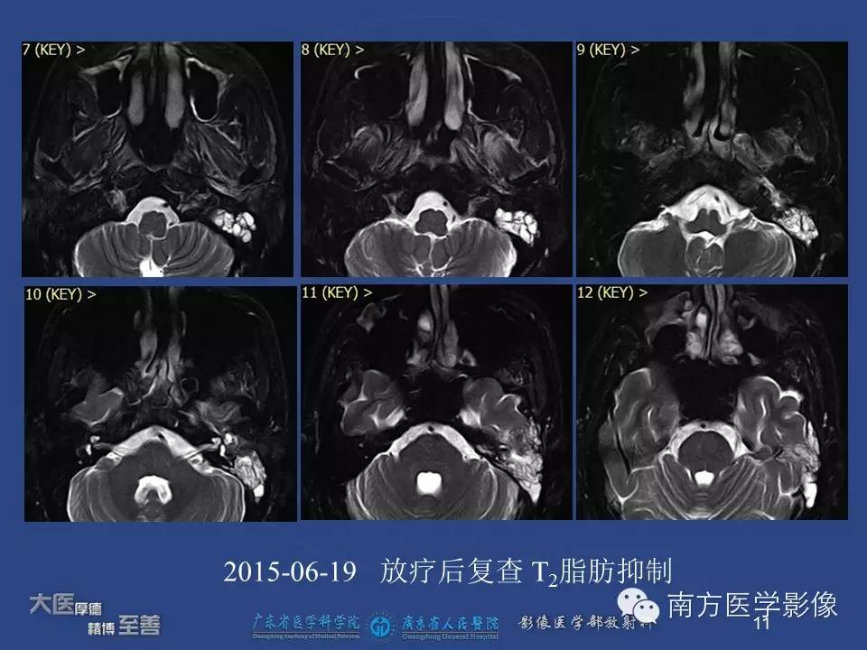 影像PPT - 【PPT】鼻咽癌累及中耳及与中耳炎的鉴别-11