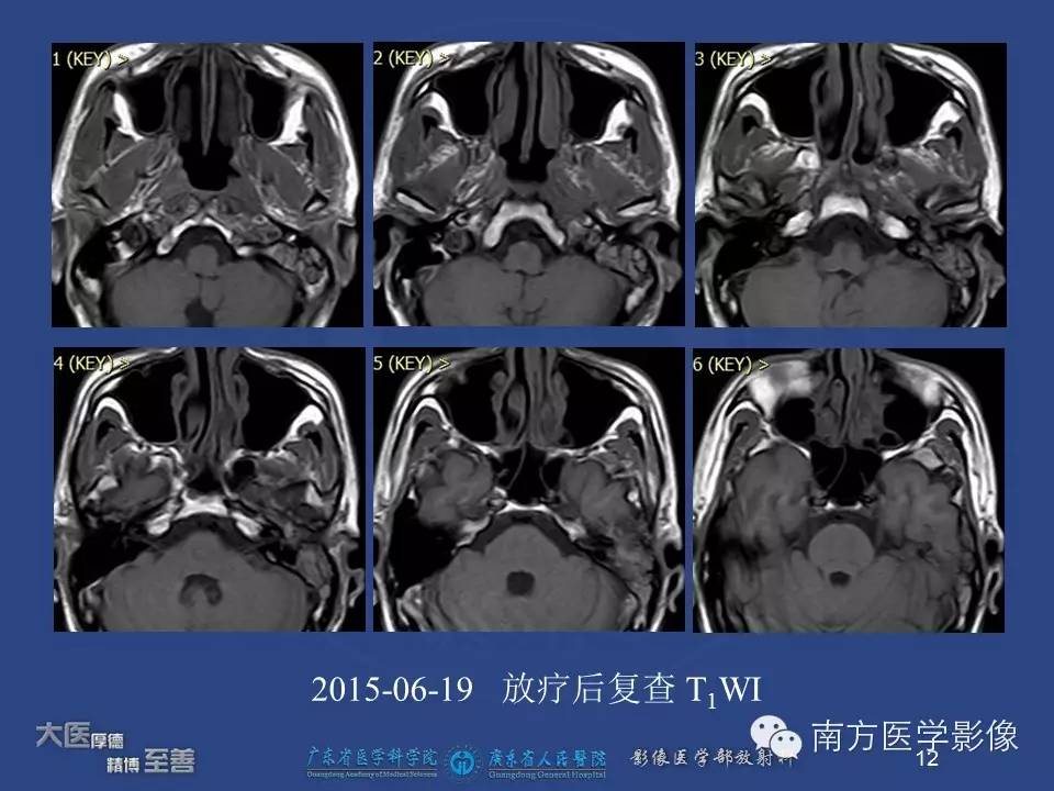 影像PPT - 【PPT】鼻咽癌累及中耳及与中耳炎的鉴别-12