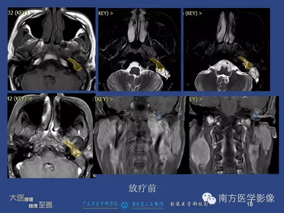 影像PPT - 【PPT】鼻咽癌累及中耳及与中耳炎的鉴别-18
