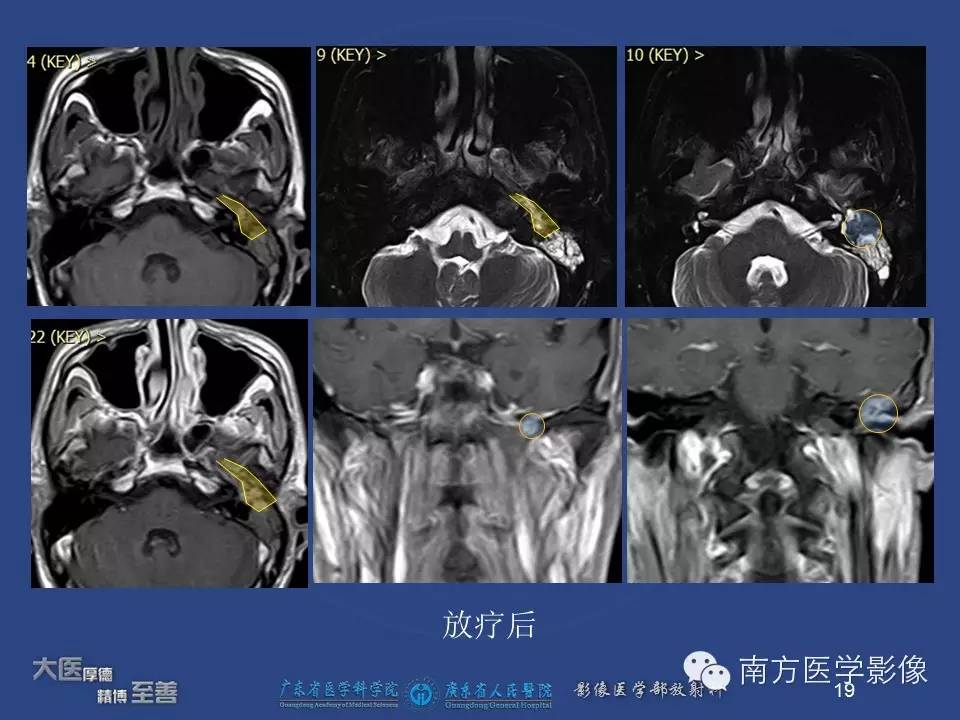 影像PPT - 【PPT】鼻咽癌累及中耳及与中耳炎的鉴别-19